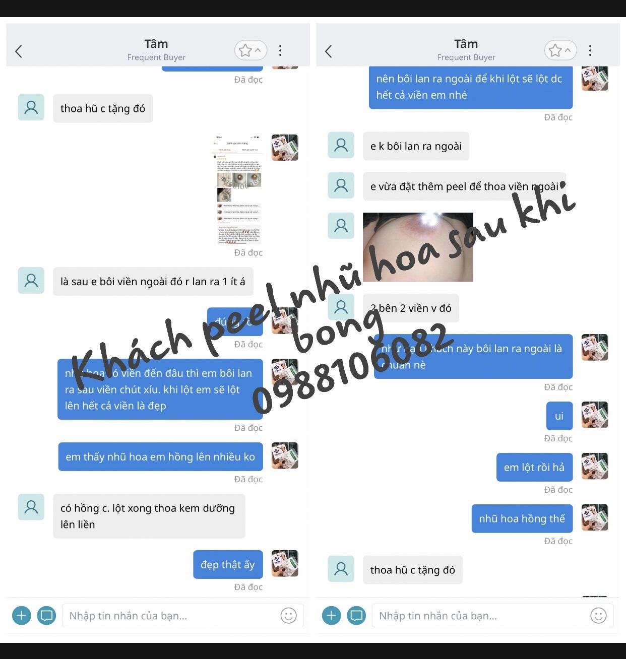 Peel làm mờ thâm nhũ hoa, nách, bikini