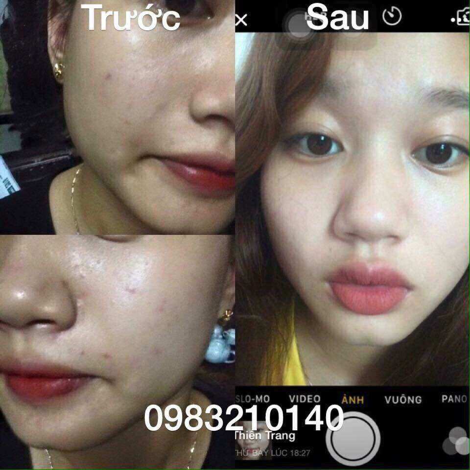 Kem Ngăn Ngừa Mụn Acne DR CELL 30gram