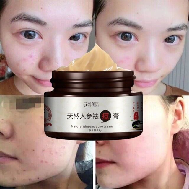Kem Giảm Mụn Chiết Xuất Nhân Sâm