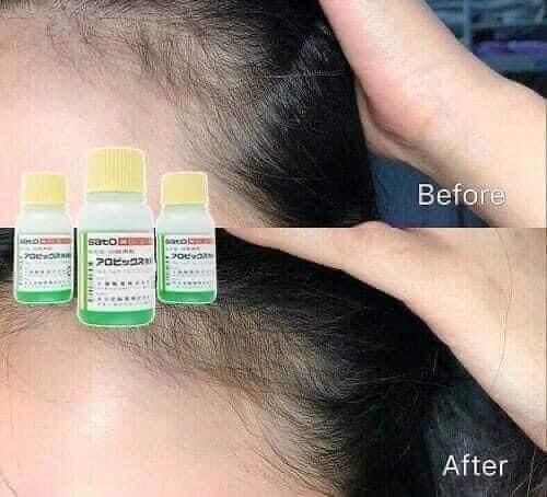 Mọc tóc Sato Nhật Bản