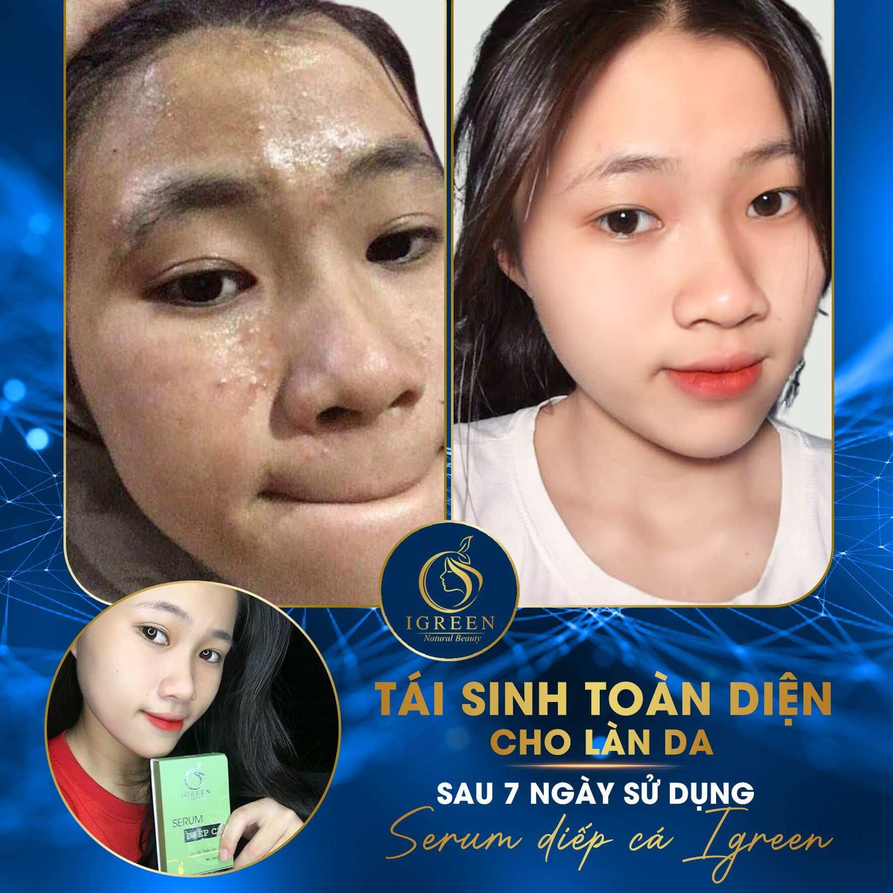 COMBO SẠCH MỤN DIẾP CÁ IGREEN