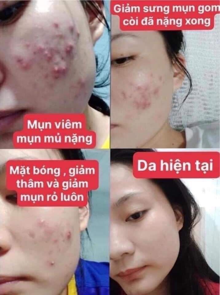 COMBO TOÀN DIỆN CHO DA HẾT MỤN, THÂM - COMBO DIẾP CÁ IGREEN