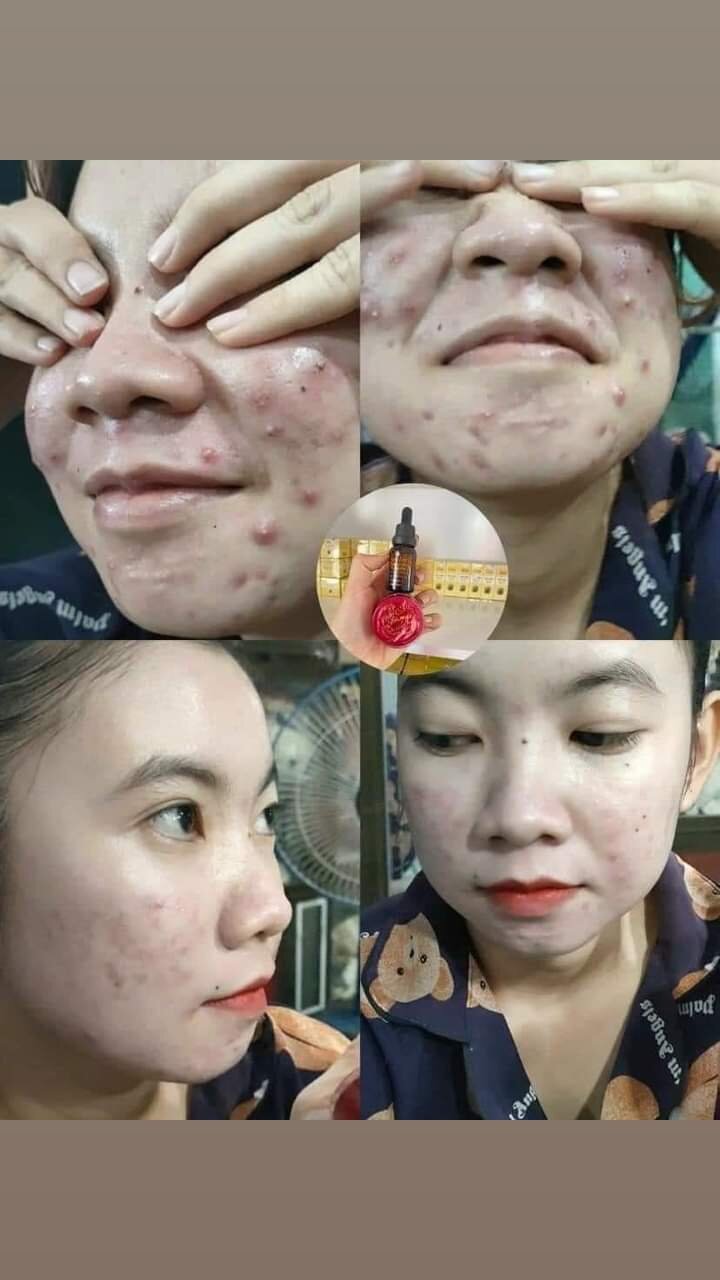 combo kem face Ngọc Oanh trị mụn nám