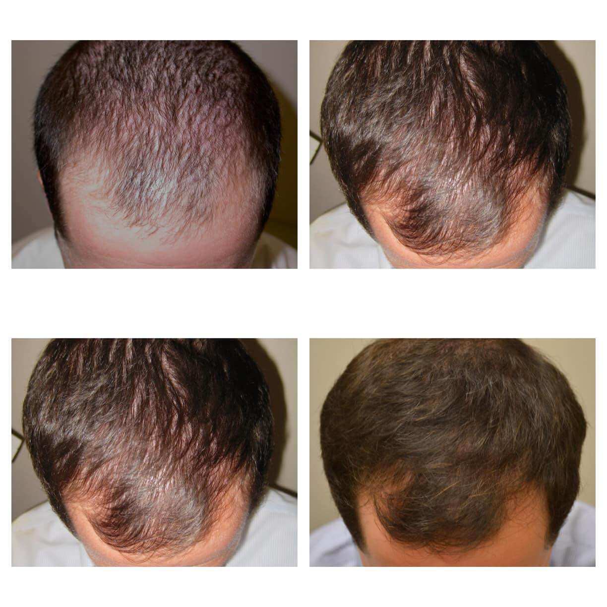 (Tặng Peo) 1 lọ Morr F5% Minoxidil hỗ trợ mọc tóc, giảm rụng tóc