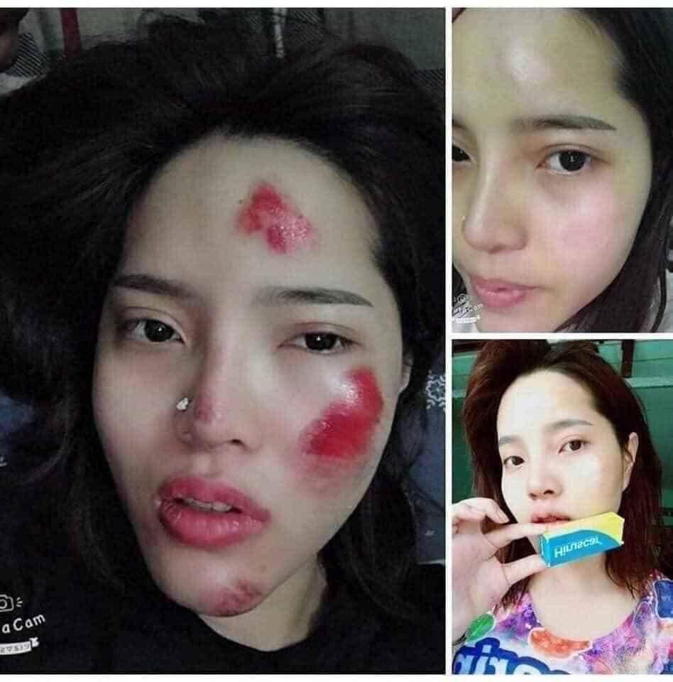 Kem sẹo Hiruscar Thái Lan