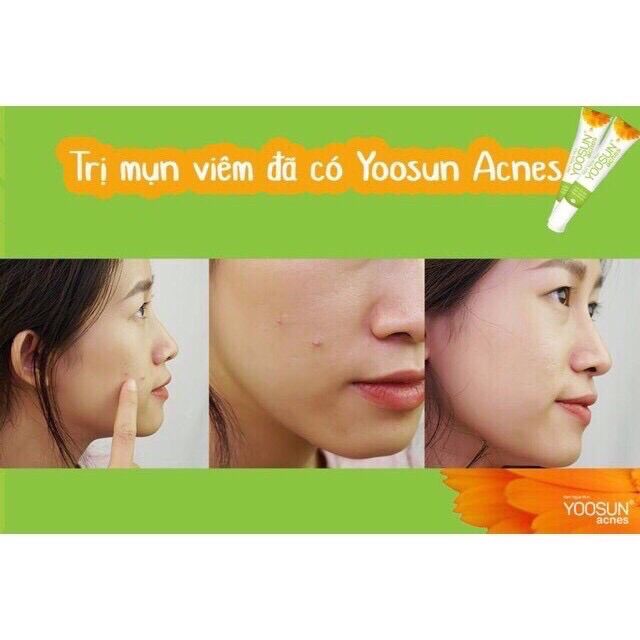 Kem Bôi mụn Yoosun acnes 15g