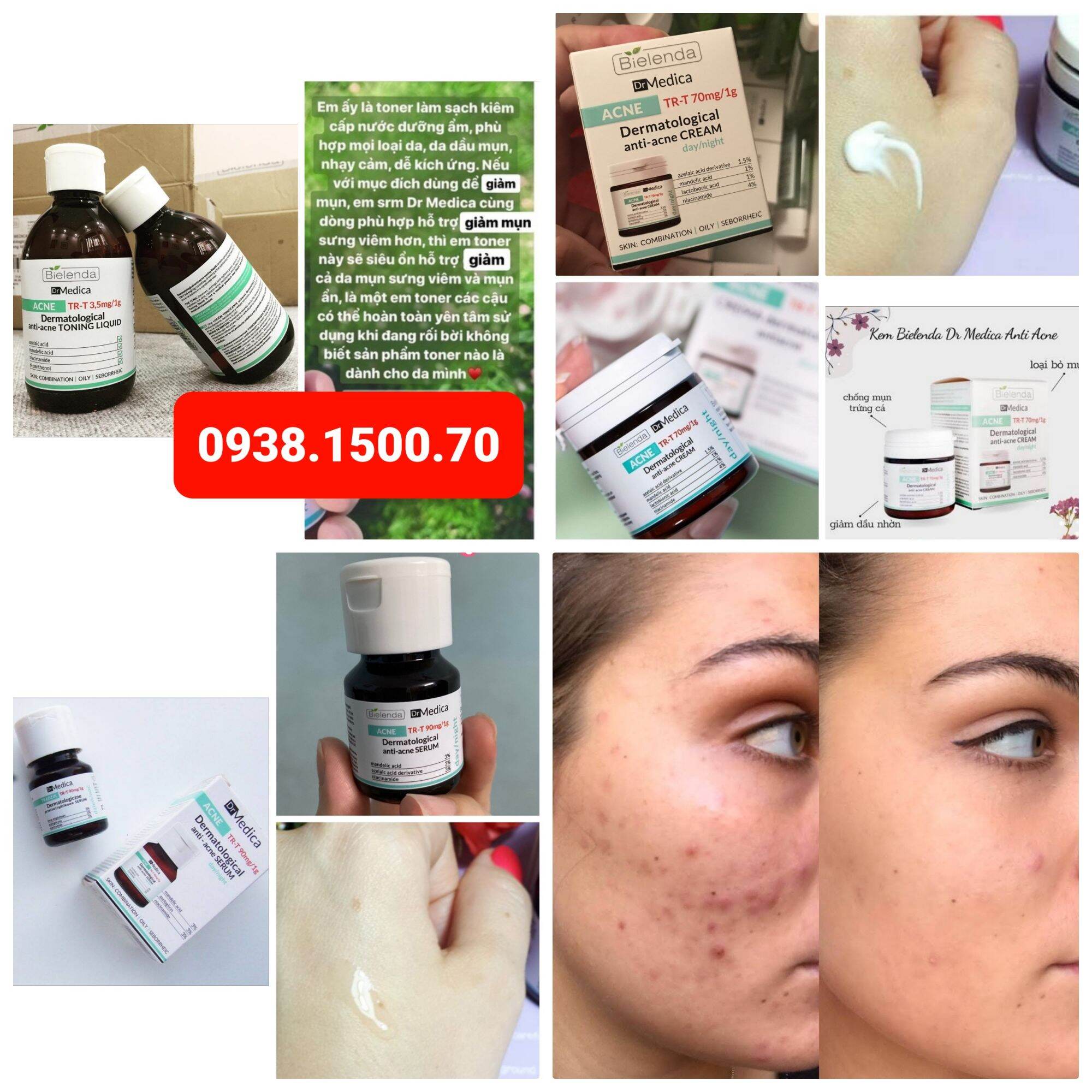 Nước Hoa Hồng Cho Da Dầu, Mụn Bielenda Dr Medica Acne Dermatological Anti-Acne Toning Liquid 250ml