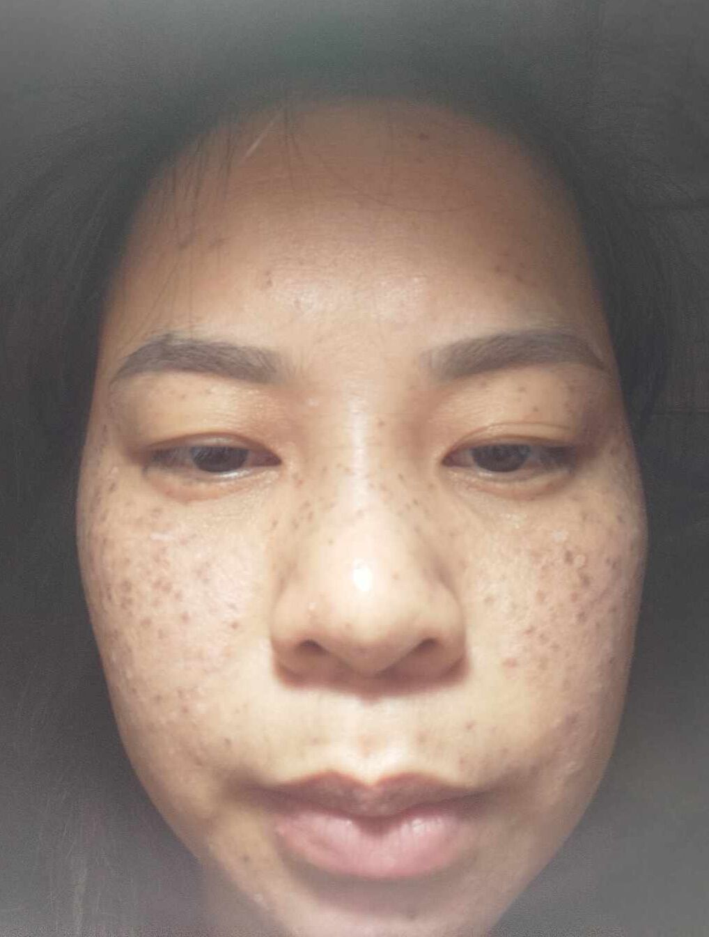 chấm tàn nhang, nám, sẹo rổ, nốt ruồi. mụn thịt, bán đinh( tuyệt đối ko bôi nguyên chất)  sp dành cho spa.