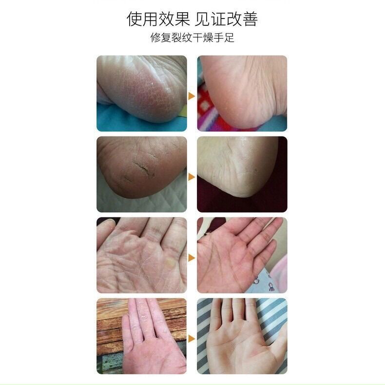Kem Ngựa Giảm Nứt Gót Chân