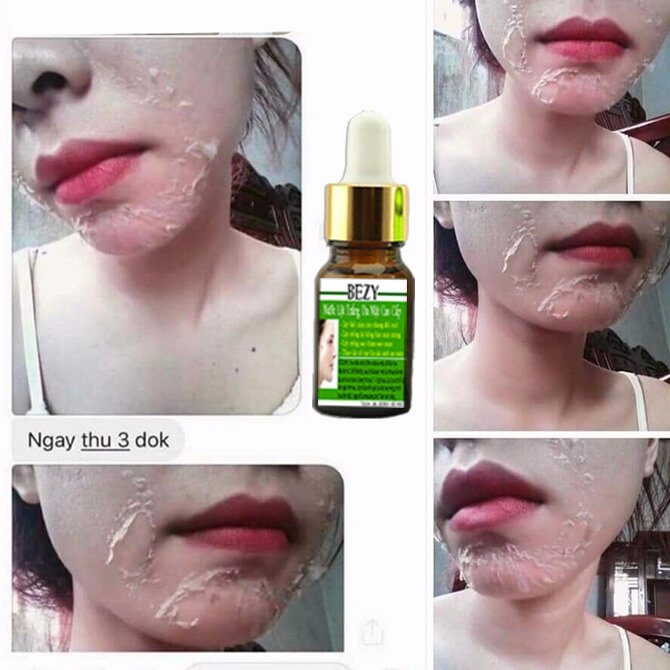 Peel Da Mặt Xóa Nám Sạm Tàn Nhang Trắng Da Bezy