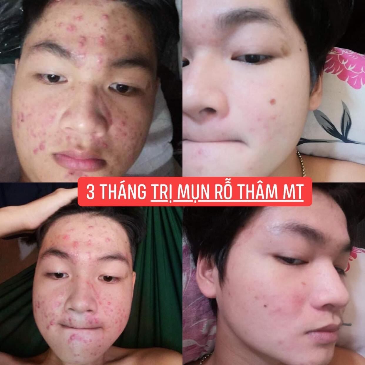 Compo Thảo Dược Sạch Mụn và Bột rửa mặt sạch dầu (50ml)
