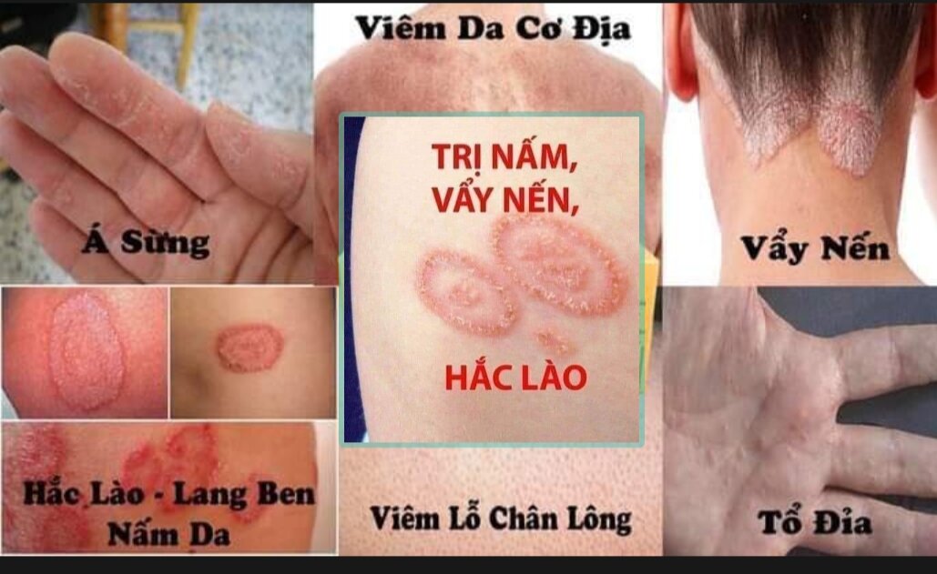 TD Bôi Hắc lào nấm ngứa ngoài da, vảy nến,á sừng tổ đỉa.....ĐY Gia truyền
