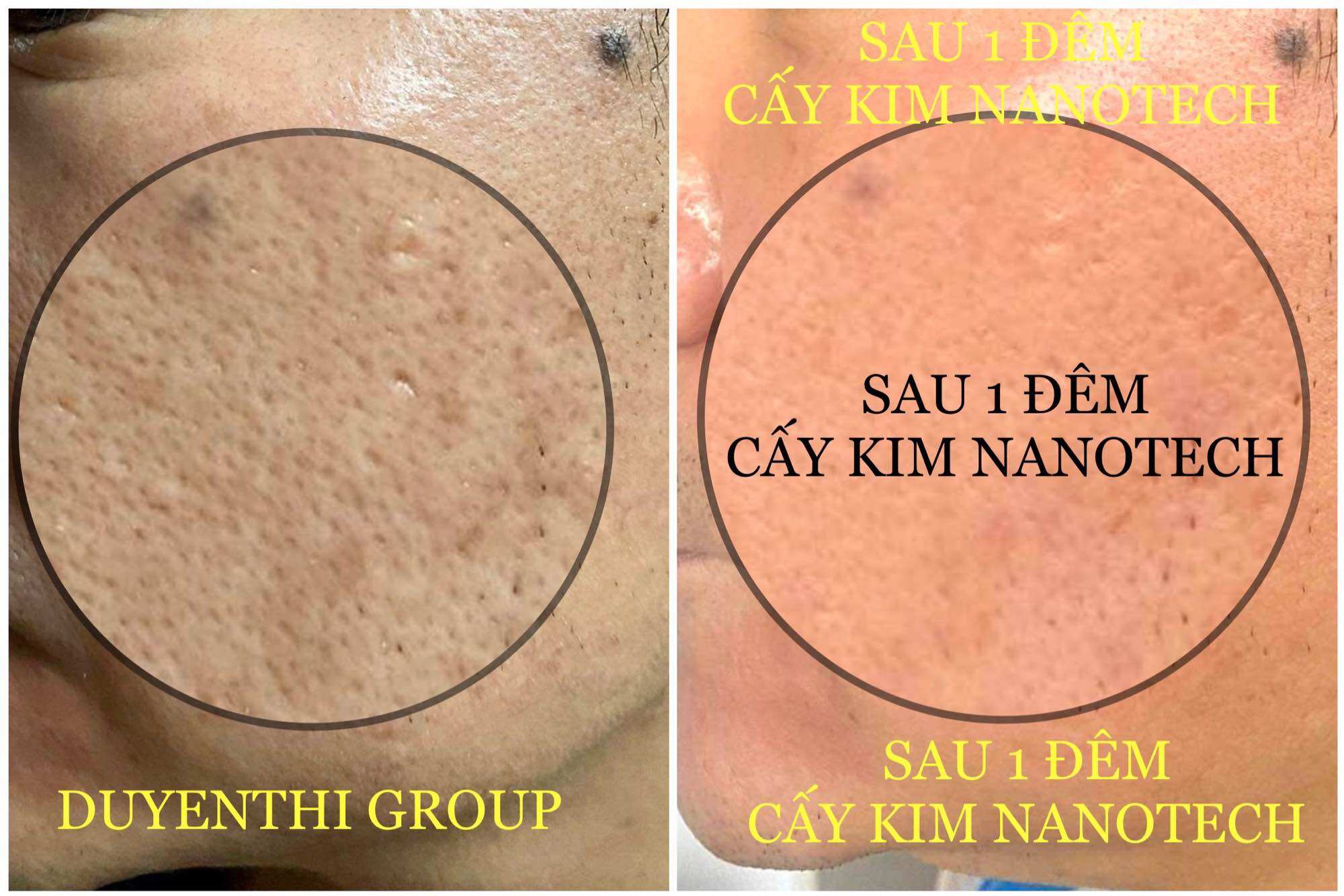 Bộ cấy kim nanotech Duyên Thị- Bách y sâm