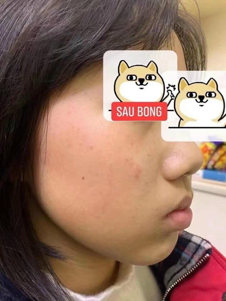 Chấm tàn nhang, nám, mụn ruồi handmade