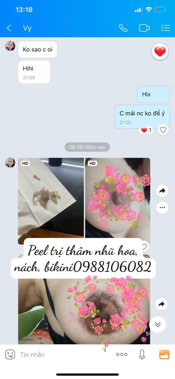 Peel làm mờ thâm nhũ hoa, nách, bikini