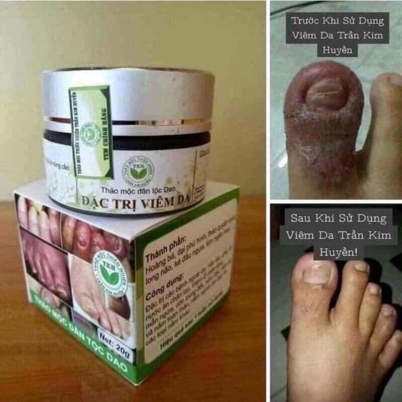 VIÊM DA ĐEN TRẦN KIM HUYỀN