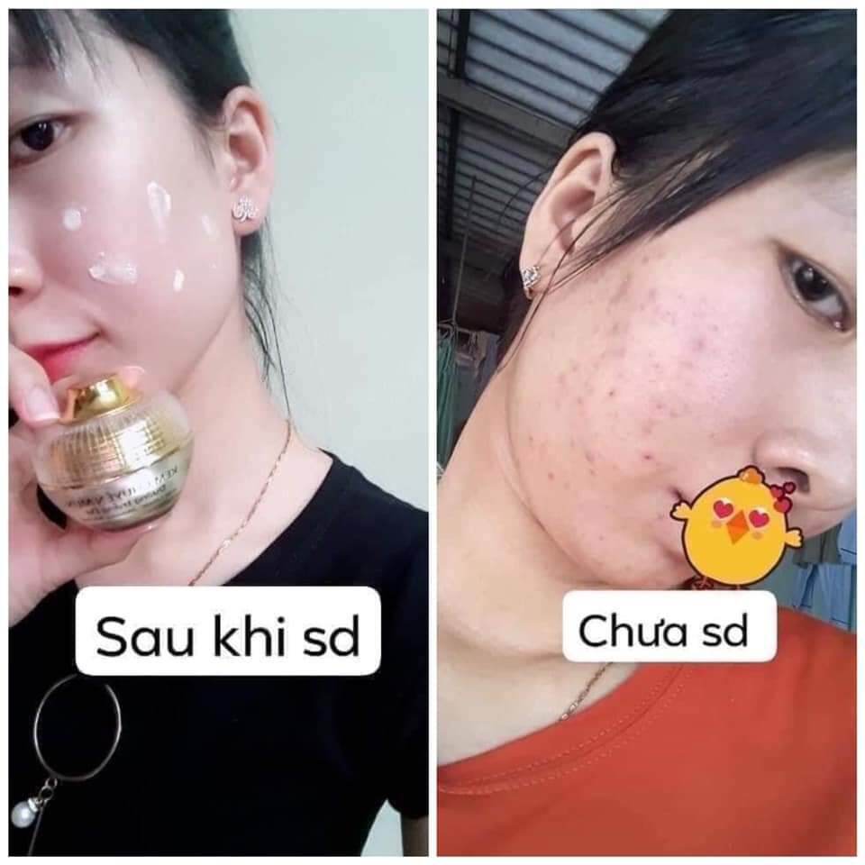 kem face chuyên mụn Huỳnh Đỗ