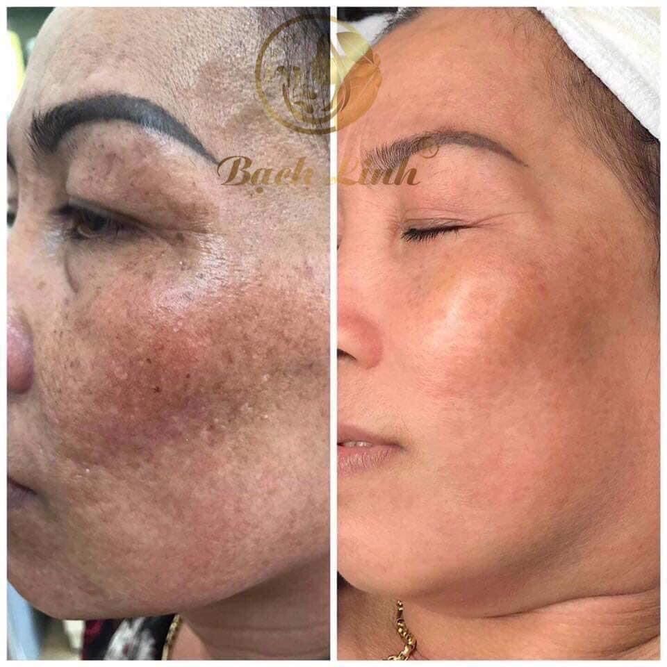 Hồng nhan phấn- bạch linh- bách y sâm(1hộp x 10gói) mẫu mới