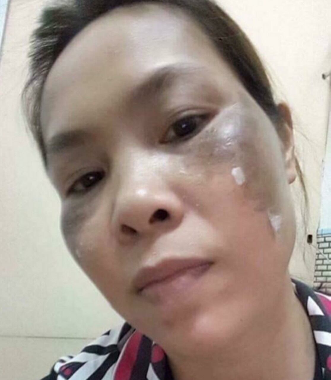 Peel Da Mặt Xóa Nám Sạm Tàn Nhang Trắng Da Bezy