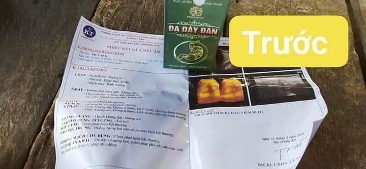 DẠ DÀY ĐAN 👉 trào ngược dạ dày 👉ợ nóng.ợ chua.đau dạ dày