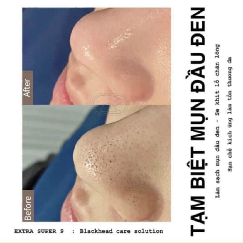 Dung Dịch Ủ Mụn Đầu Đen Remove Blackhead