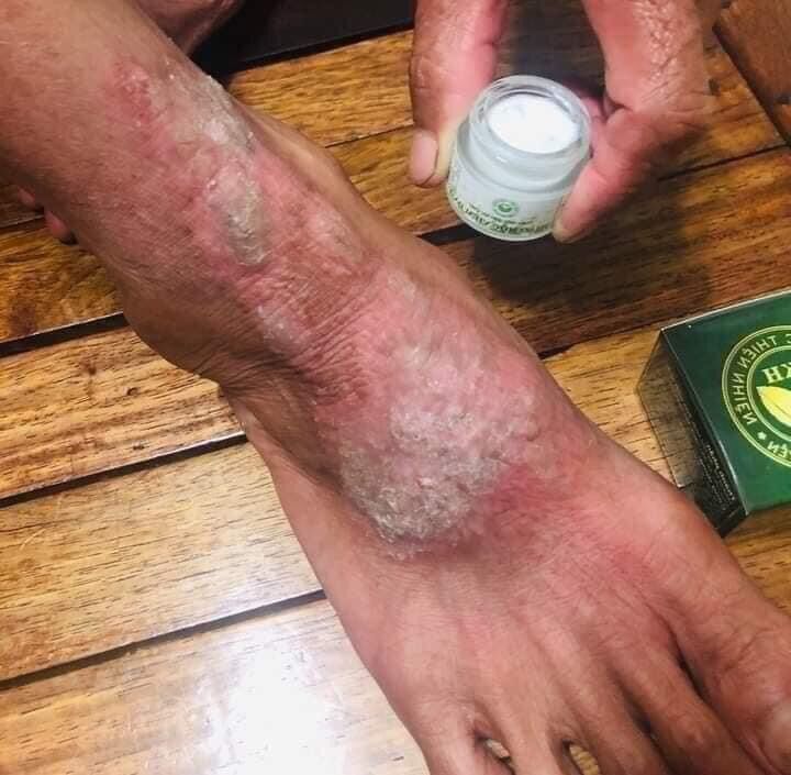 Thảo mộc bôi da Trần Kim Huyền