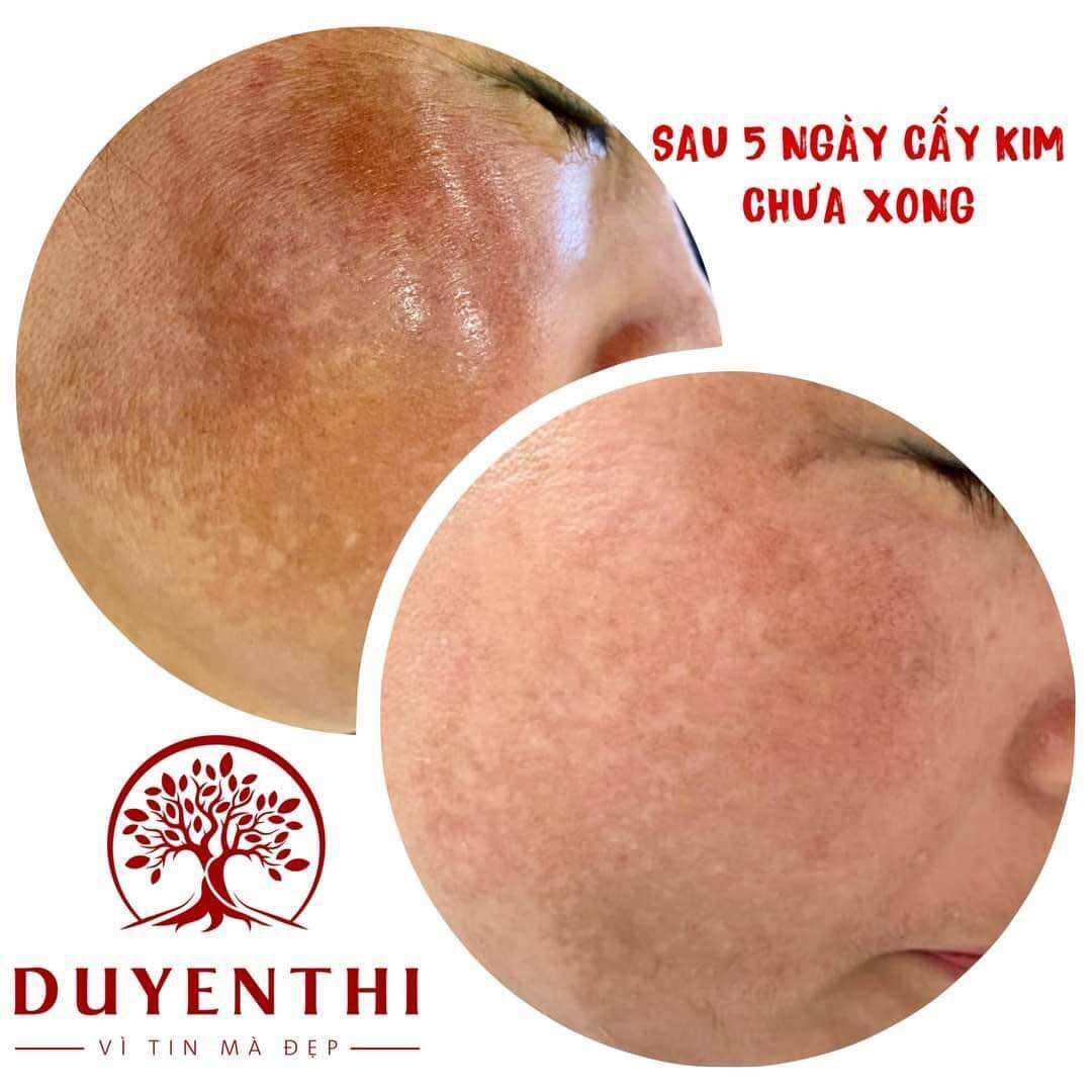 Bộ cấy kim nanotech Duyên Thị- Bách y sâm