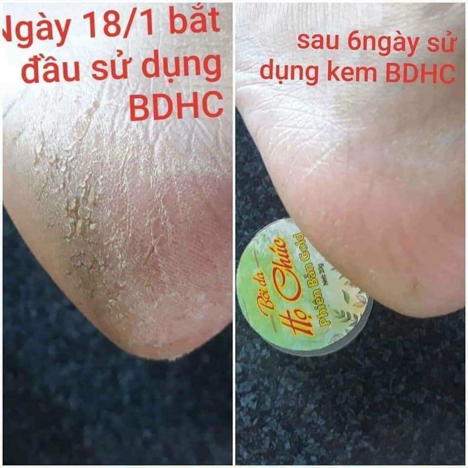 Kem Bôi Da Họ Chúc