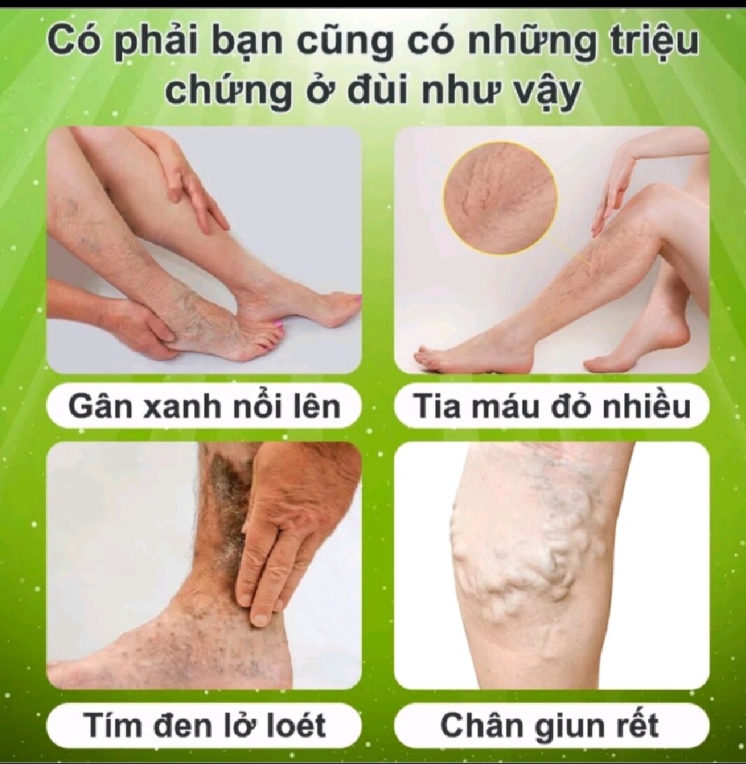 KEM BÔI SUY GIÃN TĨNH MẠCH