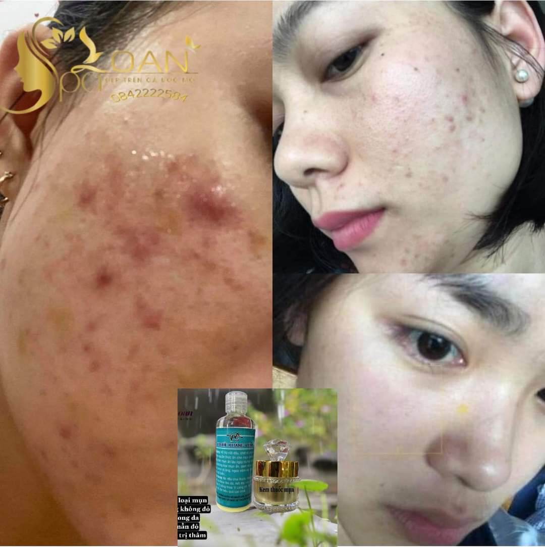 Kem mụn , giải quyết các vấn đề về mụn , nhanh chóng và hiệu quả.