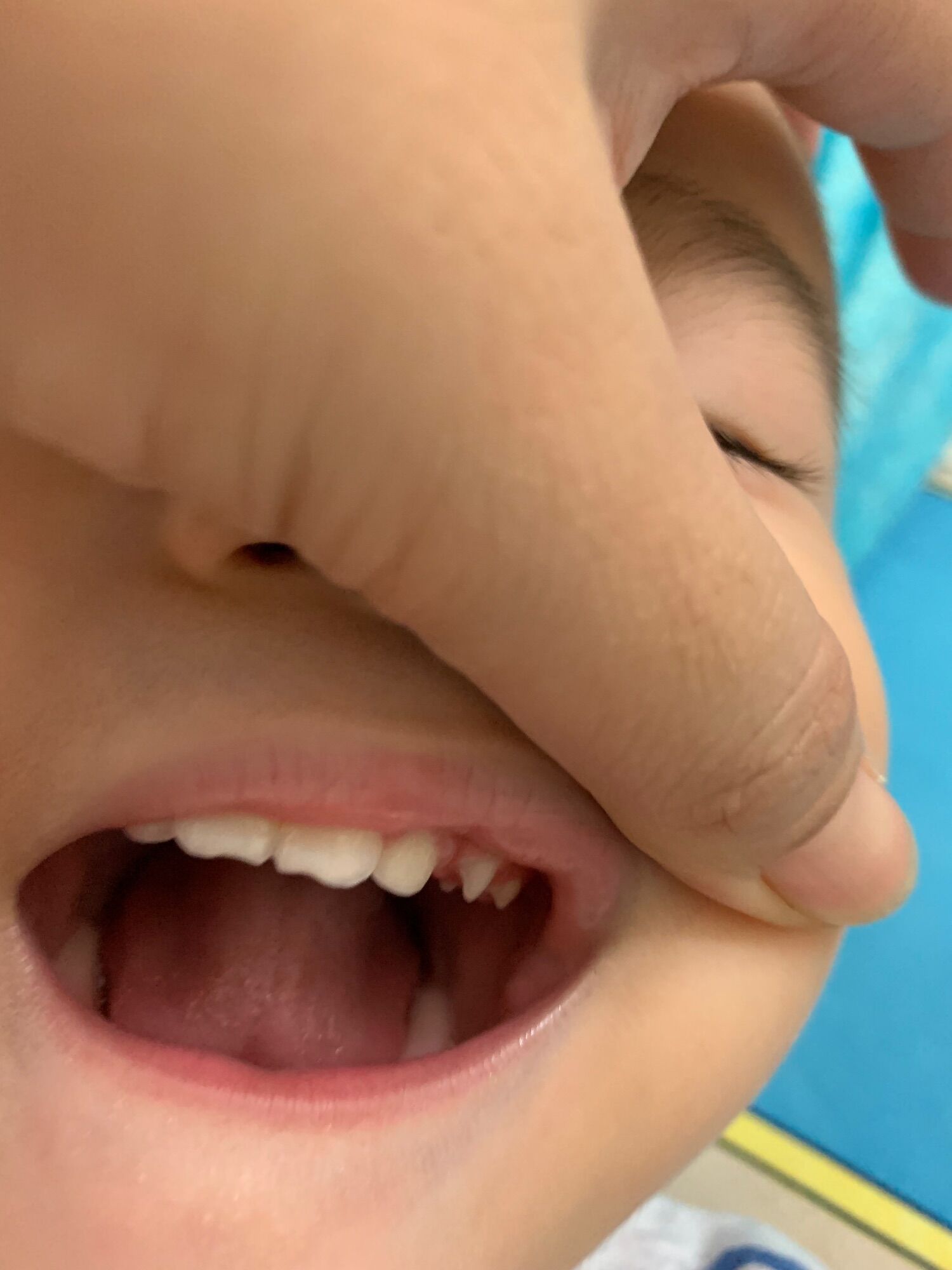 CHĂM SÓC & BẢO VỆ RĂNG MIỆNG CHO BÉ - XỊT CHỐNG SÂU RĂNG MIDKID
