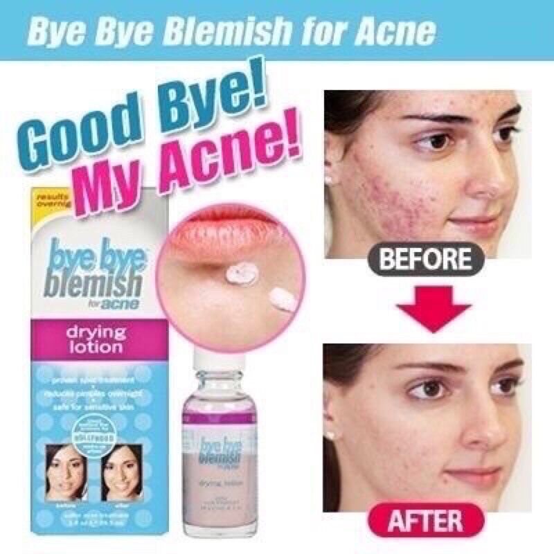 GIẢM MỤN BYE BYE BLEMISH CỦA MỸ