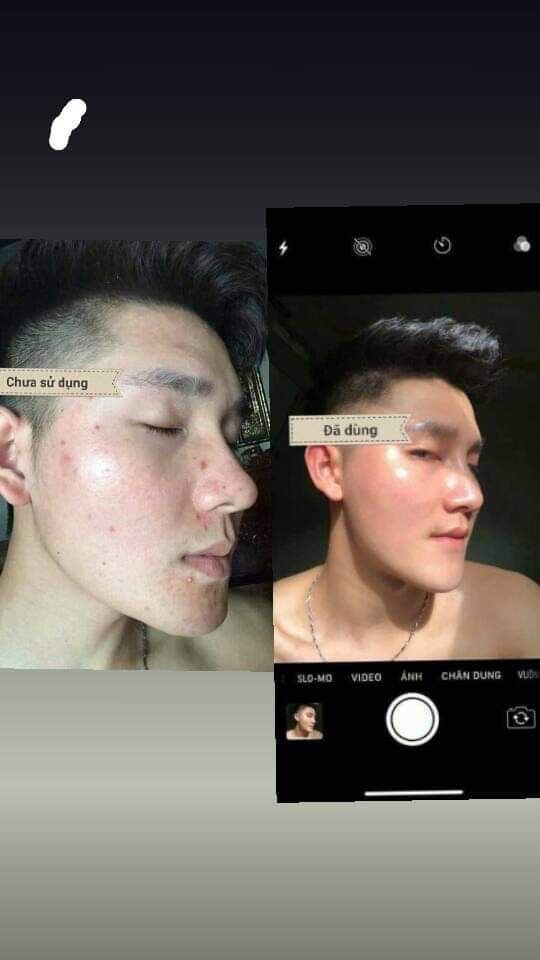 [Freeship] Dược chấm mụn dr acne Hải Âu Việt