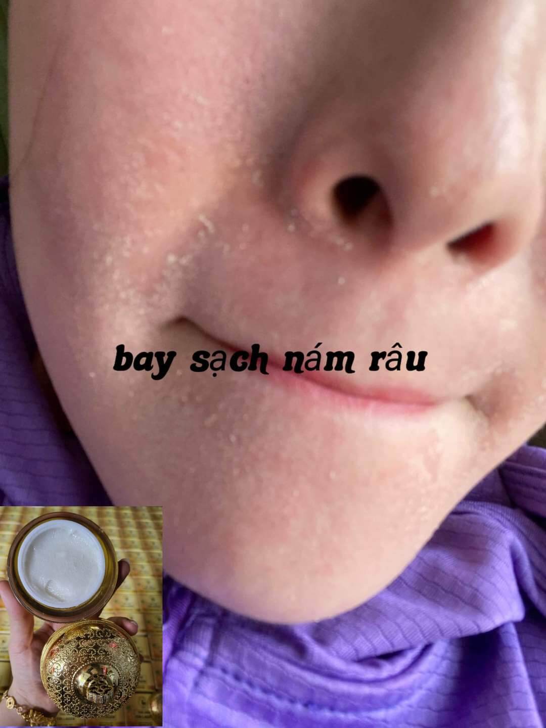 face tái tạo da. loại bỏ vết nám tàn nhang đồi mồi, xóa thâm mụn trẻ hóa da, giúp da trắng sáng mịn màng, sản phẩm phù hợp cho mọi loại da.