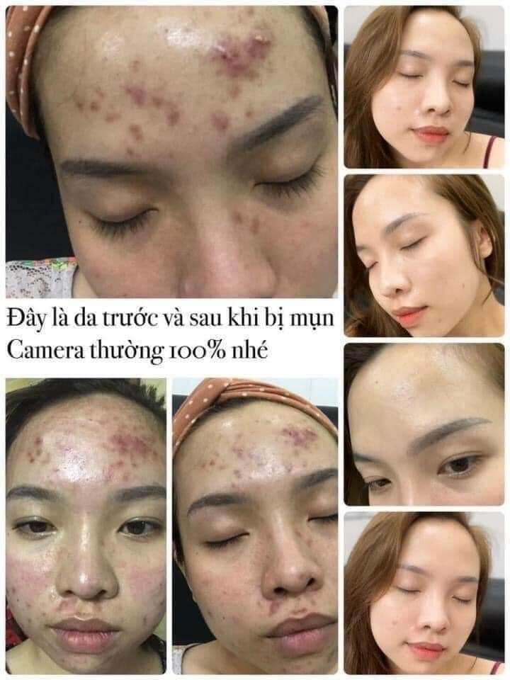 Đông Y Mộc Nhân Tái Tạo Da Cao Cấp