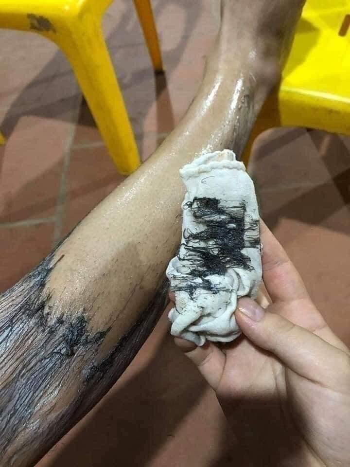 KEM TRIỆT LÔNG NANO GEL vĩnh viễn