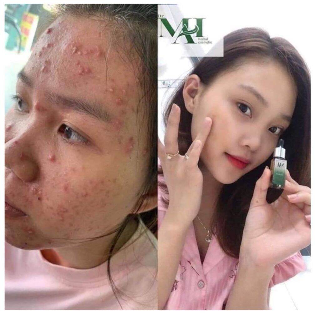 Serum Trị Mụn Thần Thánh Đẹp Datrắng Hồng Căng Bóng Se Khít Lỗ Chân Lông....