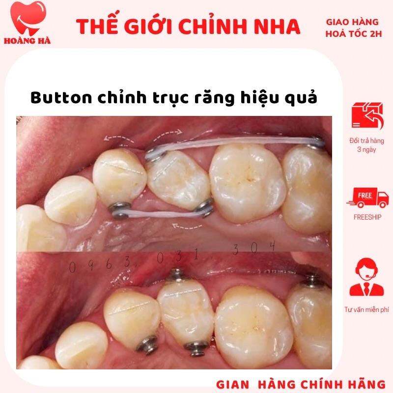 Núm buton chỉnh trục răng hỗ trợ chỉnh nha button butom buttom chỉnh nha túi 10 cái