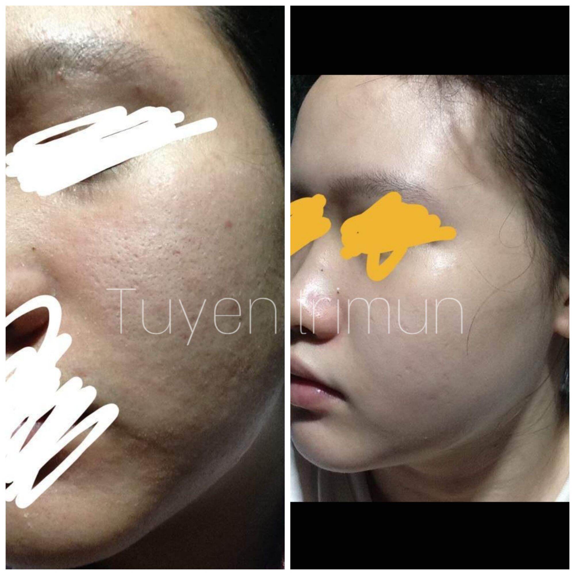 Đông y Sắc Ngọc Nữ  tái tạo da mụn, thâm
