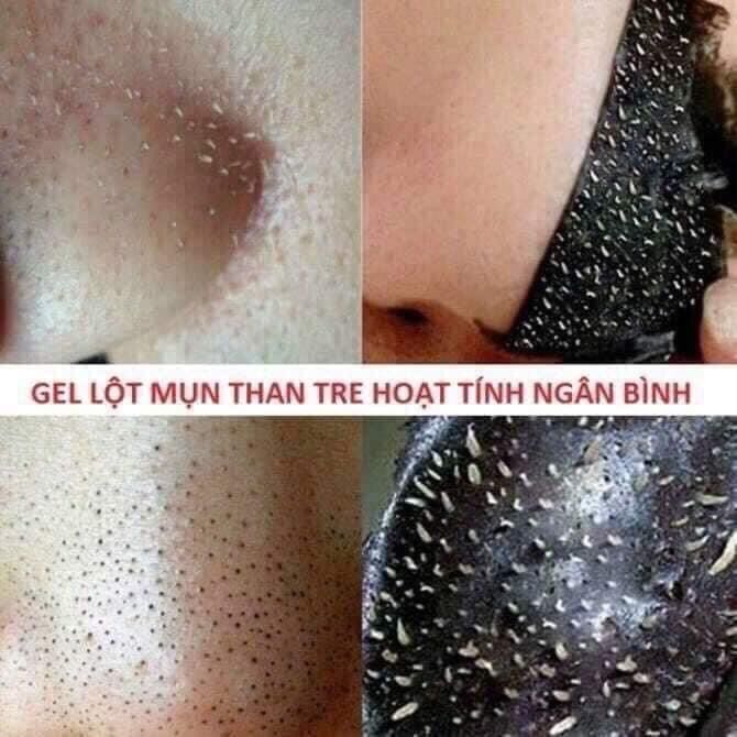 Gel hút mụn than tre hoạt tính NGÂN BÌNH