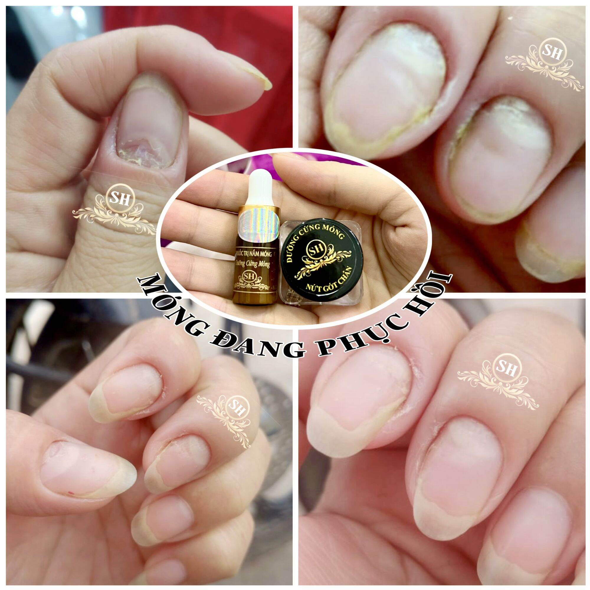 Combo (1 chai nấm+ 1 lọ dưỡng hiệu SH) đánh bay nấm móng+ phục hồi hư tổn ở móng