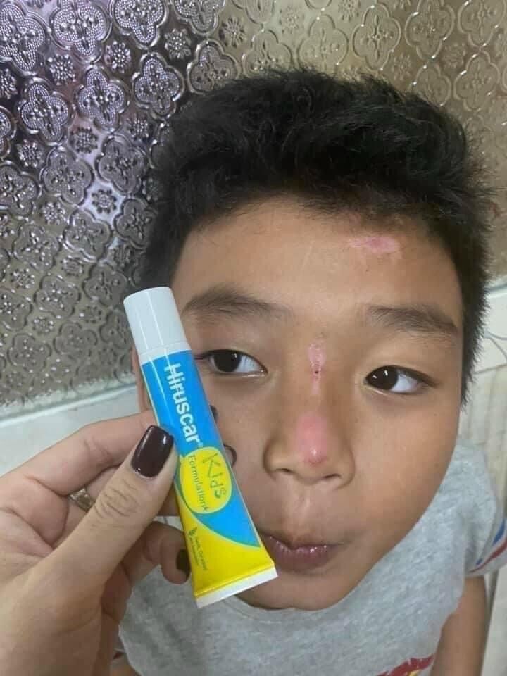 Kem bôi sẹo hiruscar kids thái lan