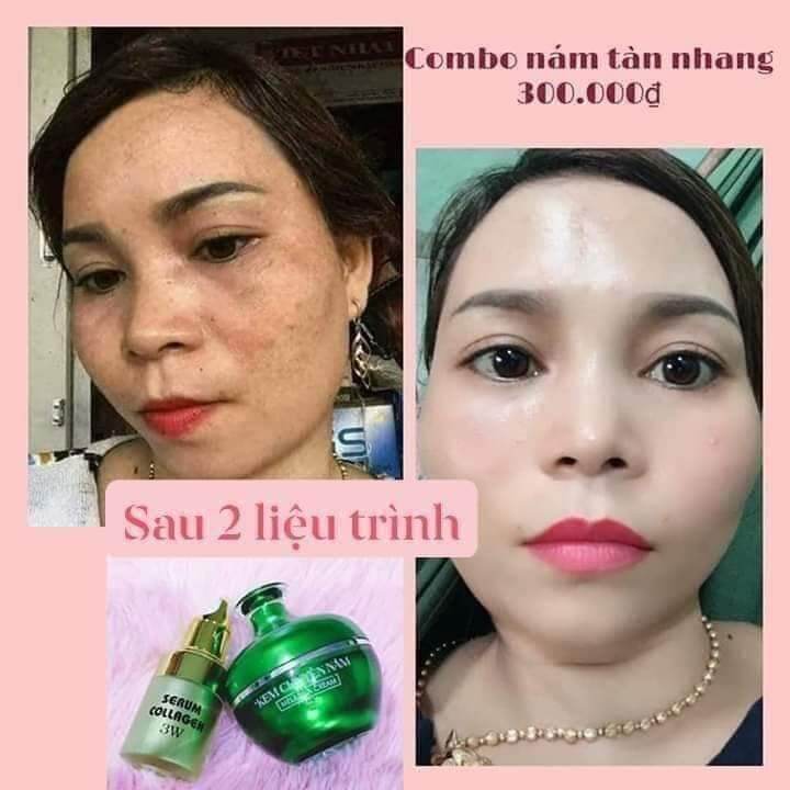 Kem chuyên nám huỳnh đỗ