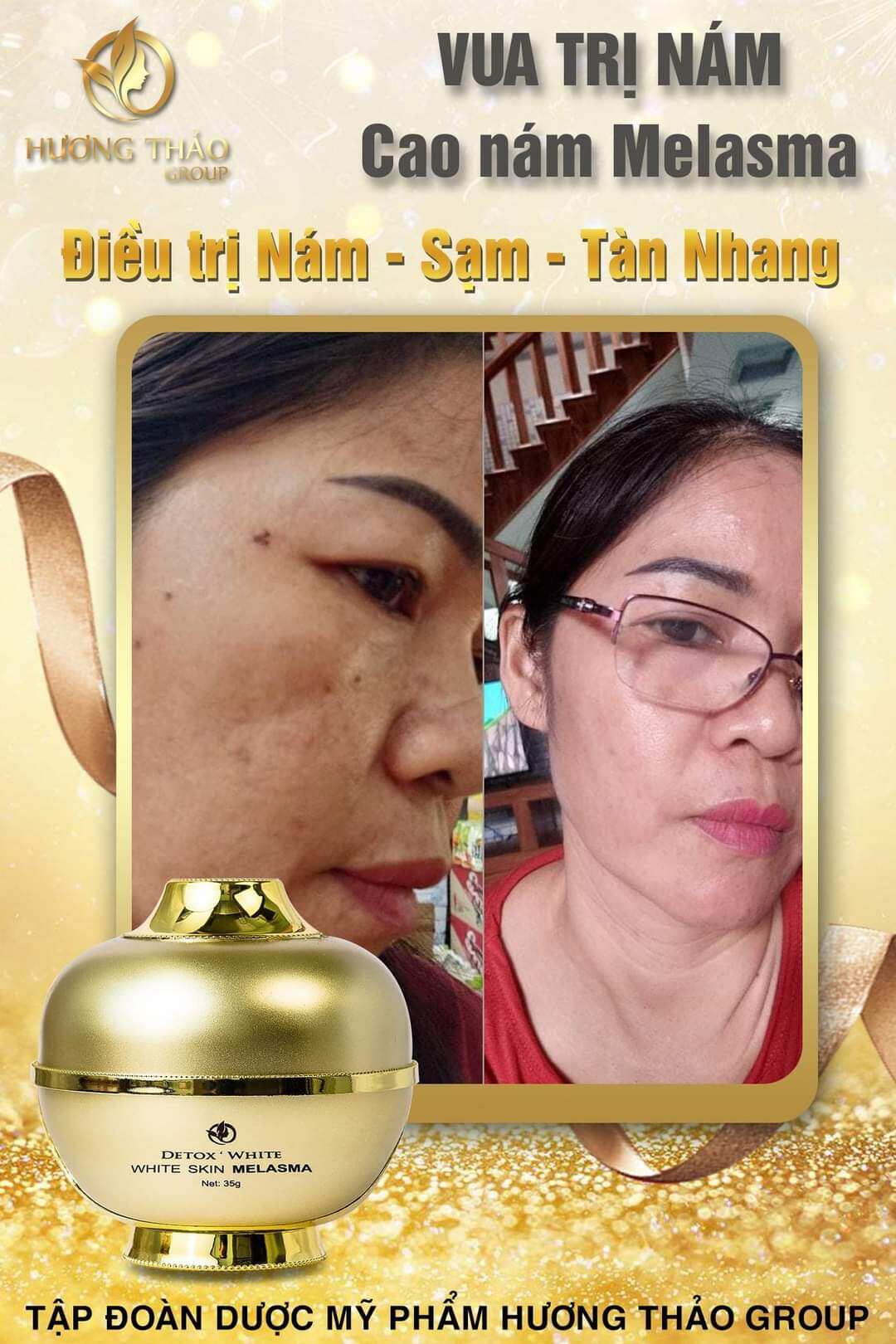 CAO NÁM MELASMA