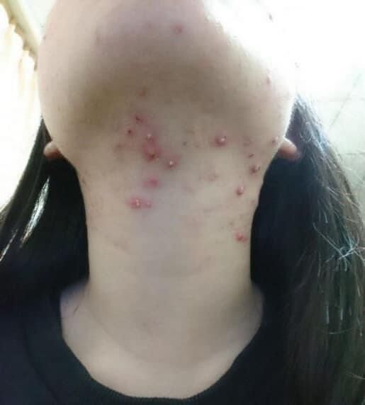 [HCM]SERUM JIUHE MỤN ACNE EXTRA THANH TÔ