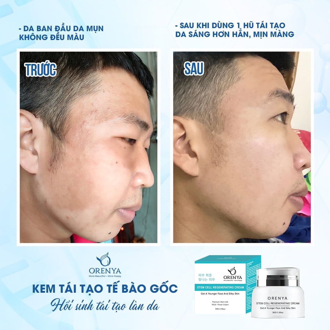 Kem tái tạo tế bào gốc