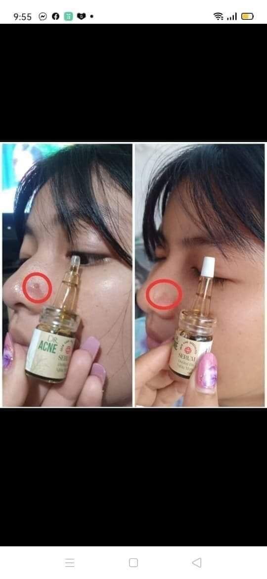 [Freeship] Dược chấm mụn dr acne Hải Âu Việt