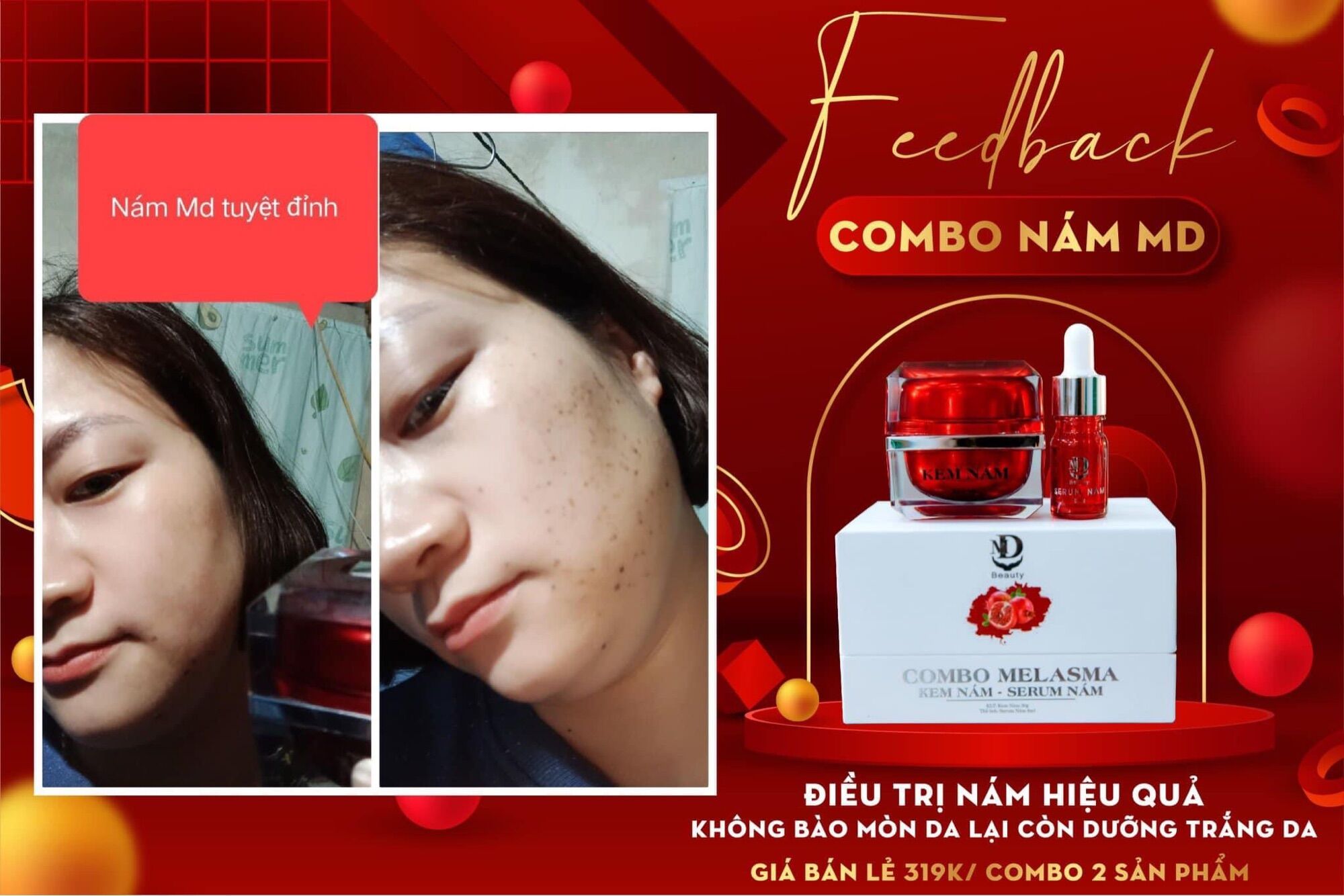 Combo sỉ 10 họp kem nám md beauty