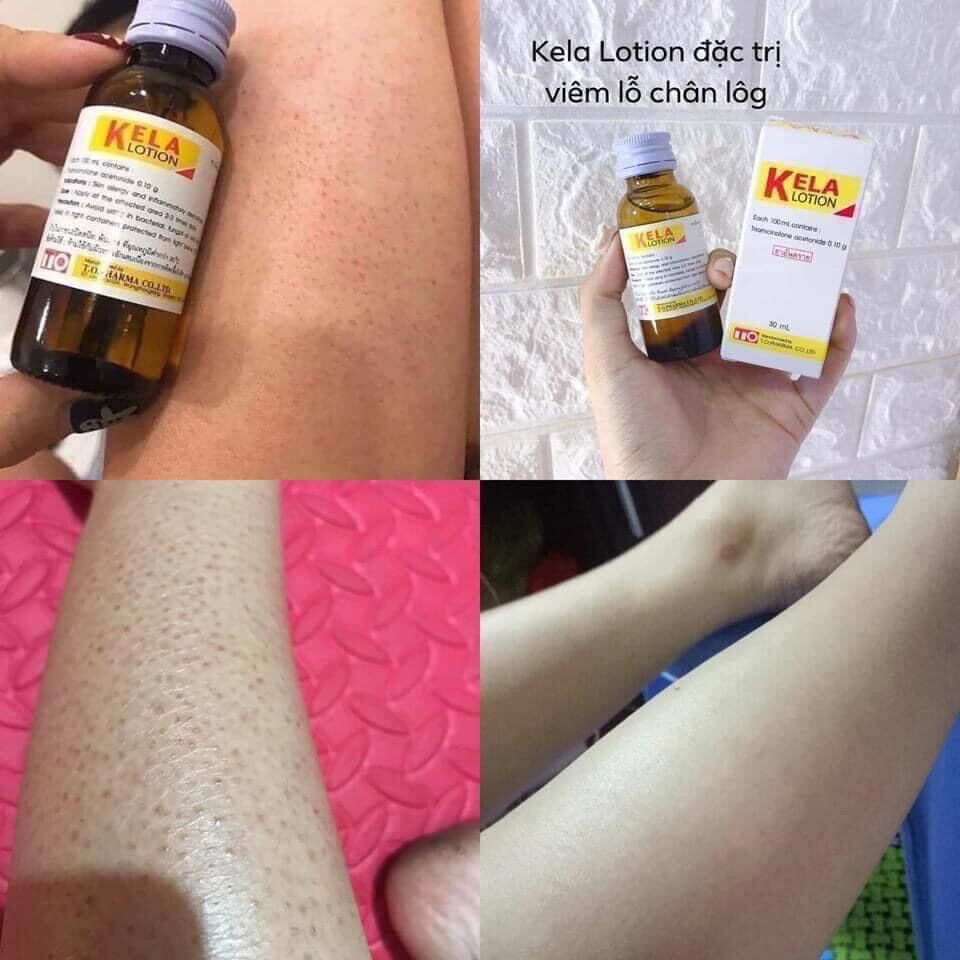 kela viêm nang lông 60ml thái lan