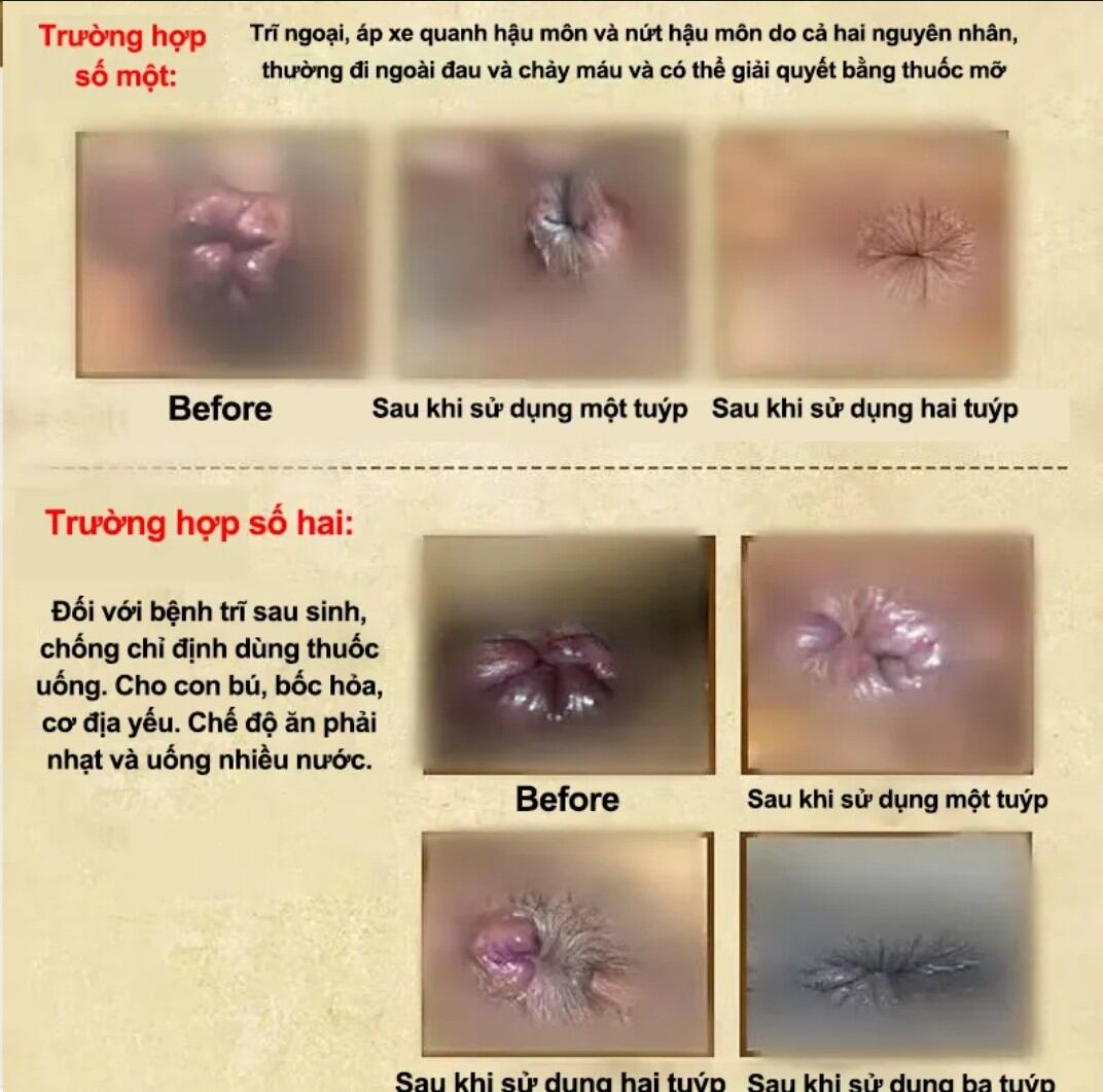 Kem bôi trĩ , hậu môn, kéo búi Trĩ.